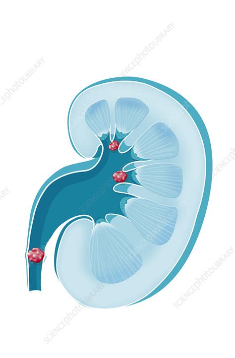 Kidney Stone Urolithiasis Lithiasis Disease Stock Image C0507238