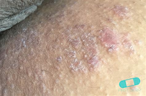 Online Dermatology Atopic Eczema