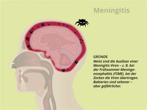 Referat Meningitis