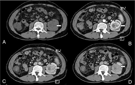 Multiphase Renal Ct In The Evaluation Of Renal Masses Is The