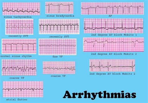 Dysrhythmia Cheat Sheet Cardiac Dysrrhythmia Aka