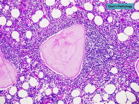 Qiaos Pathology Follicular Lymphoma Involving Bone Marro Flickr