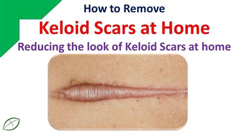 Keloid Scars What Are They And How To Prevent Them Otosection