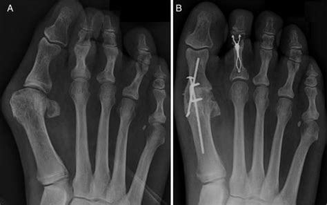 Incidence Of Nonunion Of First Metatarsophalangeal Joint Arthrodesis