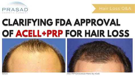 Please help as i have consulted a dermatologist in chennai for my thinning of hair in front. ACell+PRP Non-Surgical Hair Loss Treatment - Long-Term ...