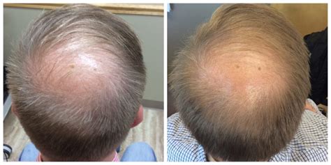 Prp Hair Loss Before And After St Louis Lipo