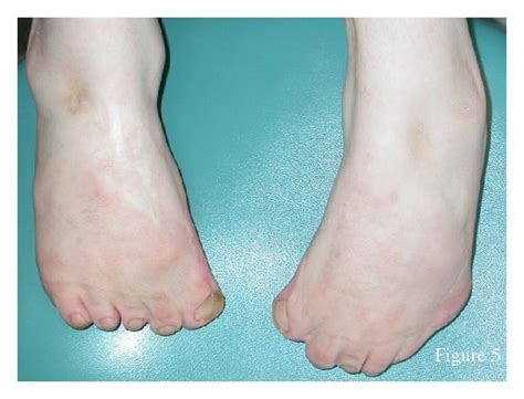 Feet Of The Patient Note Bilateral Talipes Equinovarus Download