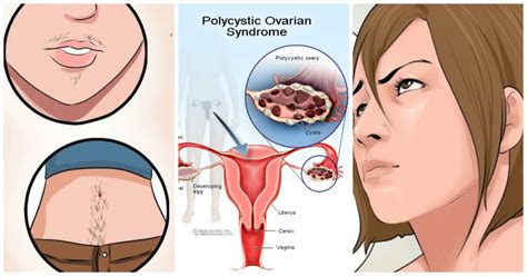 What Is Pcos What Is The Main Cause Of Pcos Fukatsoft Blog