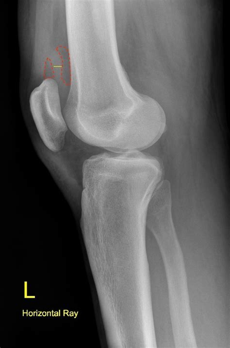 Knee Joint Effusion Radiology Case