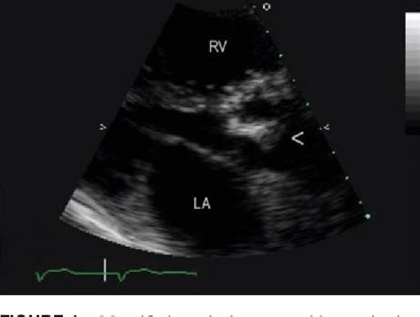 Figure 1 From Bioprosthetic Aortic Valve Infective Endocarditis
