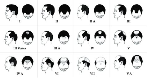 This is a classic early sign of male pattern balding. Am I Going Bald? How to Know if You're Going Bald ...