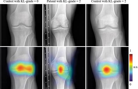 Xrays Forecast Progressive Knee Osteoarthritis