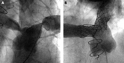Pulmonary Artery Stenting Sujyotheartclinic