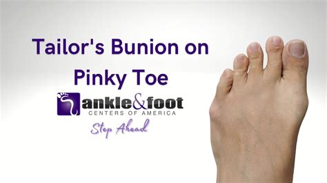 Tailors Bunion Surgery Your Comprehensive Guide