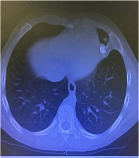 Chest Computed Tomography Scan Ct Showing A Bony Lesion On The Medial