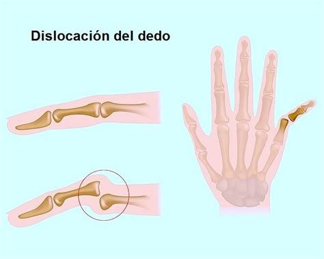 Fractura Del Dedo Mano Pulgar Menique Sintomas Y Tiempo De Recuperacion