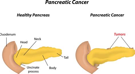 Cancer De Pancreas Causas