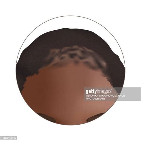 Traction Alopecia Photos And Premium High Res Pictures Getty Images