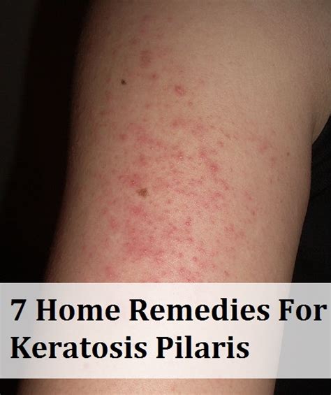 Actinic keratosis is a precancerous lesion that is commonly seen in the elderly patient and requires treatment. 7 Home Remedies For Keratosis Pilaris