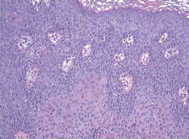 Vulvar Squamous Lesions Clinical Gate