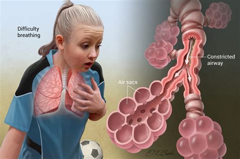 Asthma Is A Condition In Which The Airway Becomes Inflamed Narrow And Causes Swelling Produ