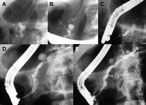 Endoscopic Retrograde Cholangio Pancreatography Ercp For Extracting