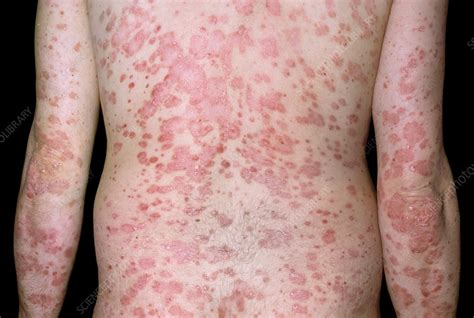 Guttate Psoriasis Stock Image C0261151 Science Photo Library