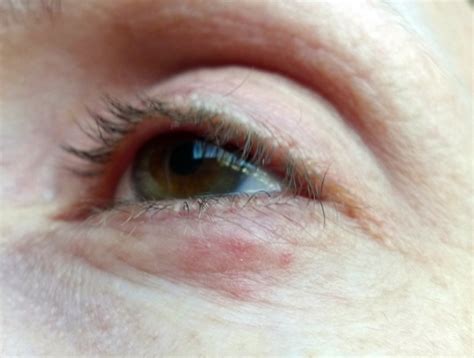 Small Red Pimples Below Lower Eyelid Dermatitis And Eczema Skin And