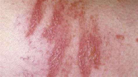 Phytophotodermatitis Symptoms Causes And More