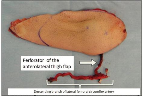 Application Of Free Flow‐through Anterolateral Thigh Flap For The