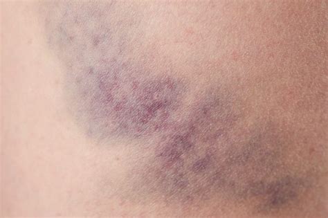 Leukemia Unexplained Bruising 13 Signs Of Cancer Men Are Likely To Ignore