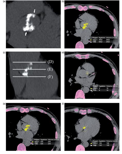 Figure 1 From Association Between Aortic Valvular Calcification And Characteristics Of The