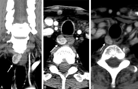 Diagnostic Accuracy Of 4d Ct For Parathyroid Adenomas And Hyperplasia