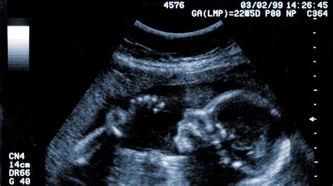 20 Weeks Ultrasound Girl