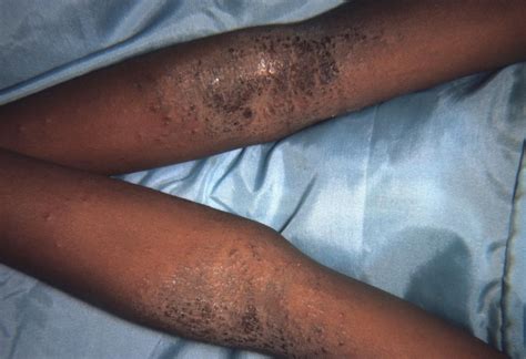 Eczema On Black Skin Pictures Symptoms And Treatment