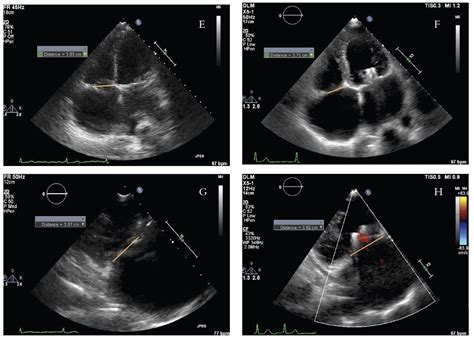 Percutaneous Tricuspid Valve Regurgitation Repair With The Mitraclip