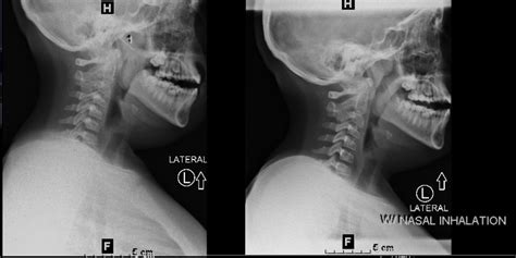 X Ray Soft Tissue Neck Chattanooga Imaging