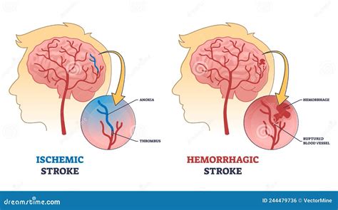 Ischemic Vs Hemorrhagic Head Stroke Anatomical Comparison Outline Diagram Stock Vector