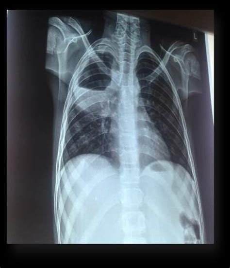 Chest X Ray Showing Thick Walled Cavity With An Air Fluid Level At The