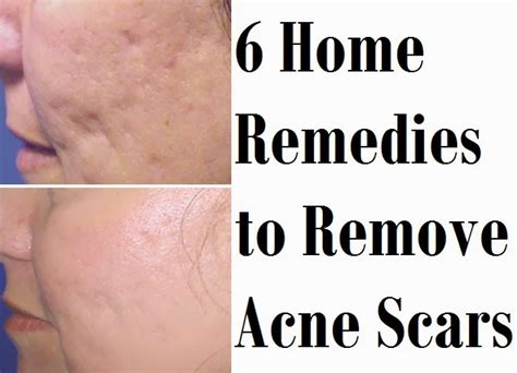 Natural Remedies For Acne Scars Dorothee Padraig South West Skin