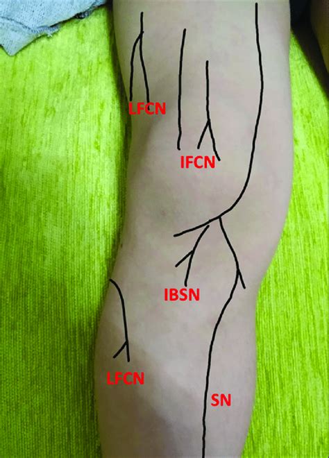 Tender Chronic Constrictive Injury Cci Points Lfcn Lateral Femoral