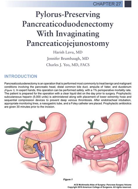 Ciné Med Pylorus Preserving Pancreaticoduodenectomy With Invaginating