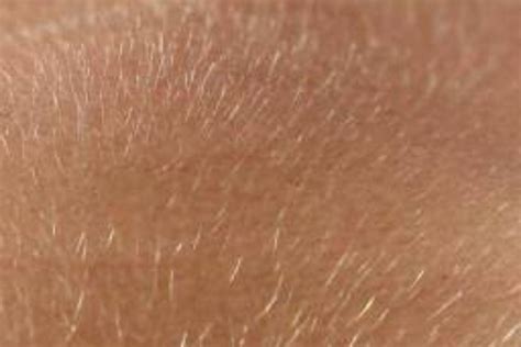 Vellus Hair Or Peach Fuzz Treatments With Dermaplaning Telford