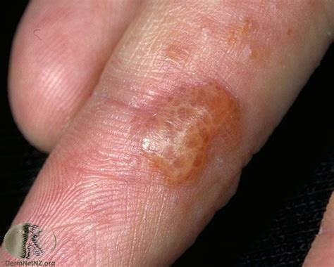 What Is Dyshidrotic Eczema Blisters On Fingers Hands Vrogue Co