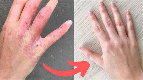 5 Secrets To Healing Your Eczema What I Learned Key Strategies To