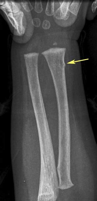 Torus Buckle Fracture Radrounds Radiology Network