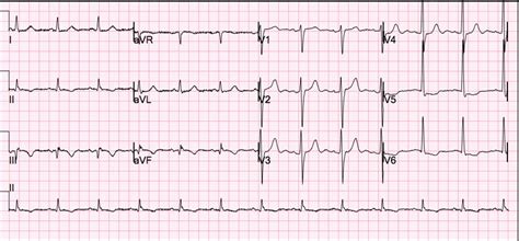 Dr Smiths Ecg Blog A Picture Of Subendocardial Ischemia