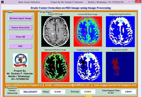 Brain Tumor Detection On Mri Images Using Image Processing Full Matlab