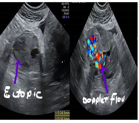 Ruptured Ectopic Pregnancy Ultrasound