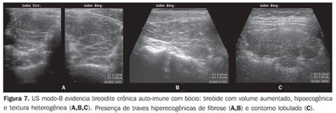 Radiologia Brasileira Importância da ecogenicidade da tireóide no